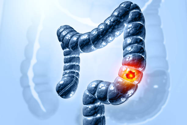 Shield: The Future of Colorectal Cancer&nbsp;Screening
